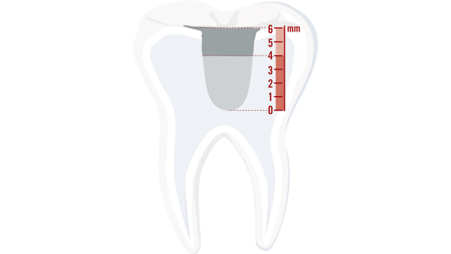 Charisma Bulk Flow ONE is ideal for deeper cavities of up to 4mm.