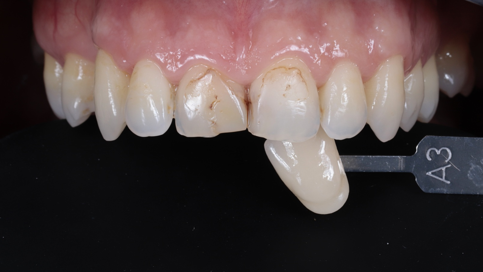 Step 1: Shade selection