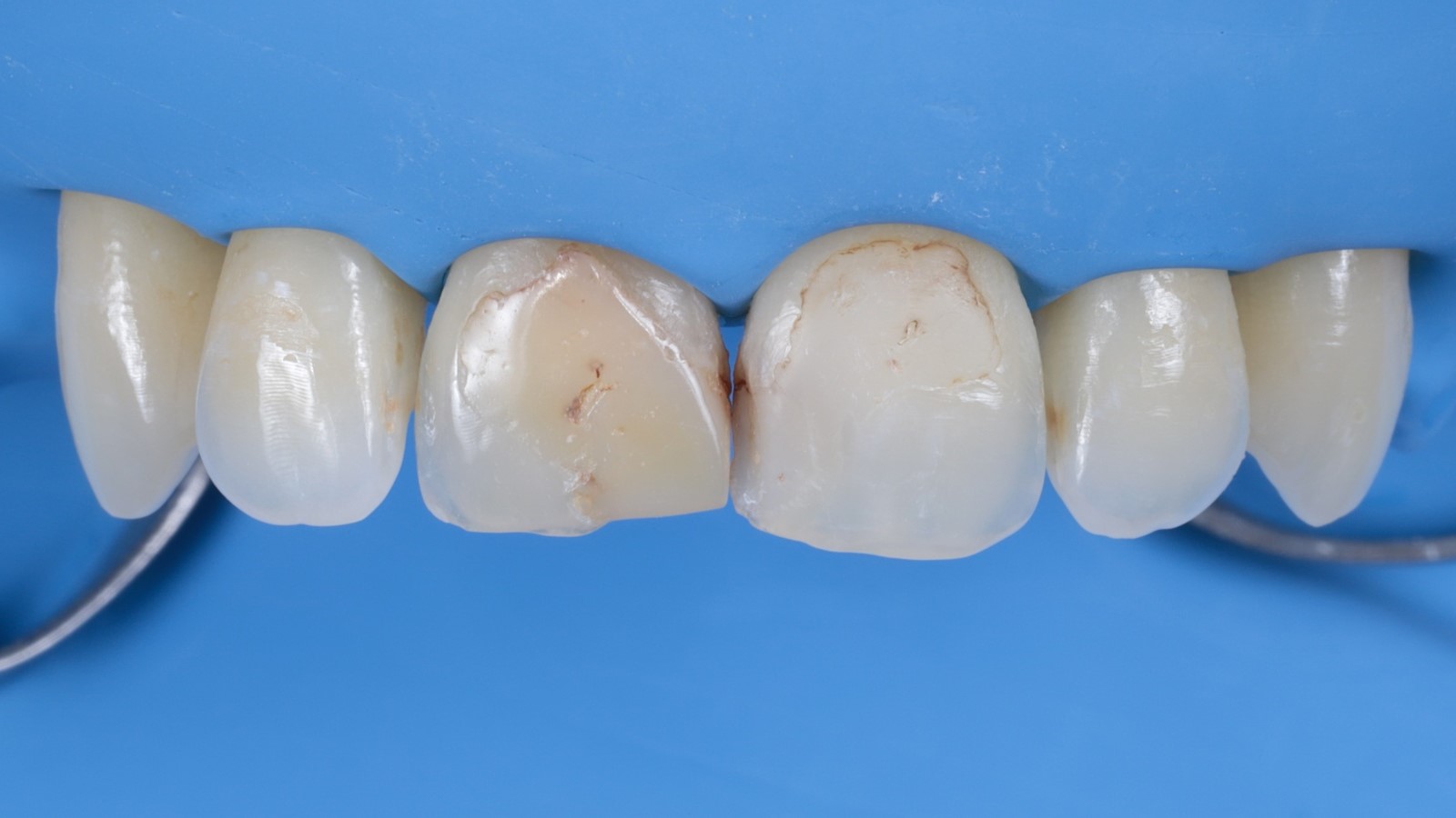 Step 2: Isolation of the operating field 