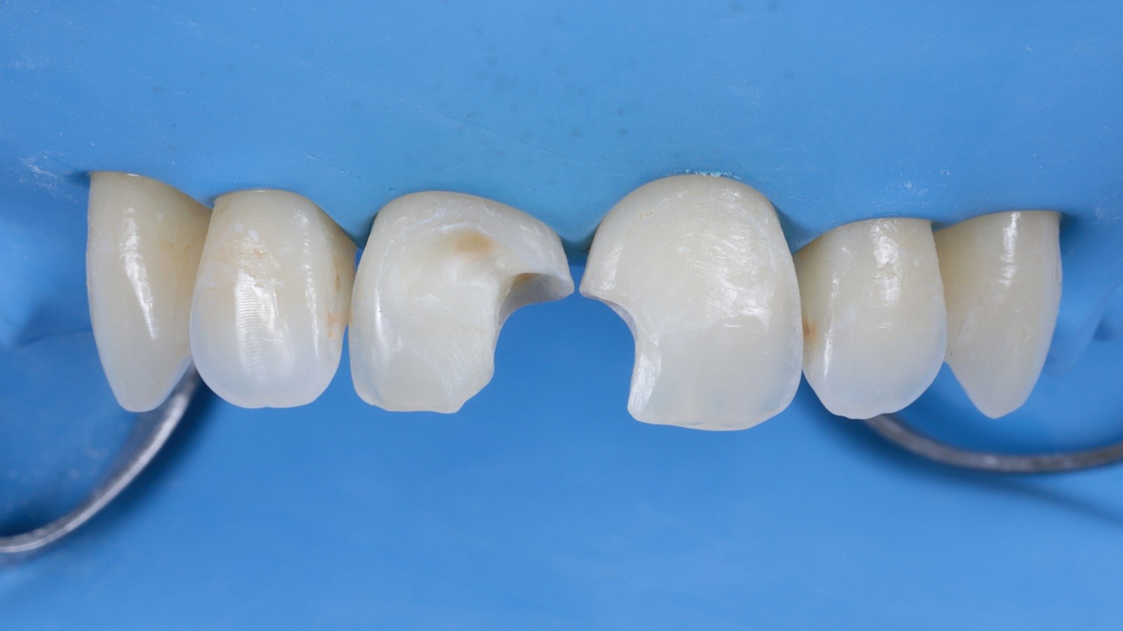 Step 3: Removal of old composite and decayed tissue 