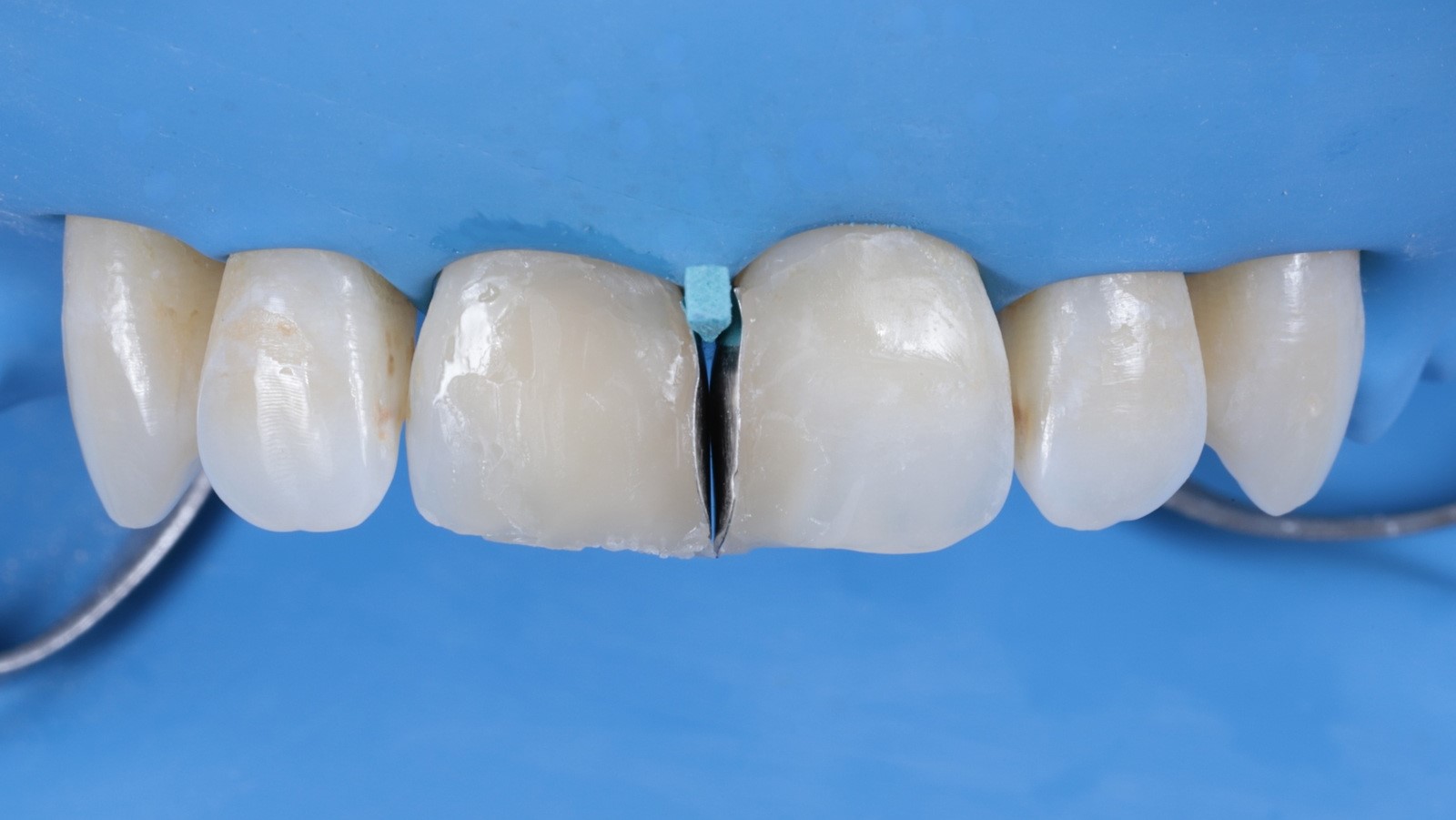 Step 5: Reconstruction with Venus Pearl Pure Shades