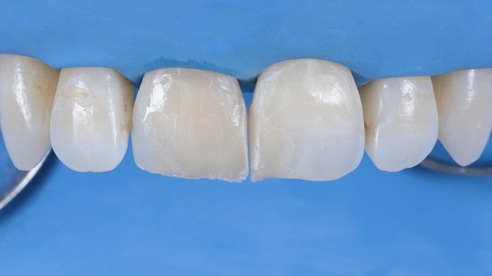 Step 6: Restorations before finishing and polishing