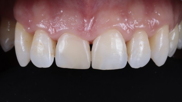 Step 9: Restorations directly after polishing