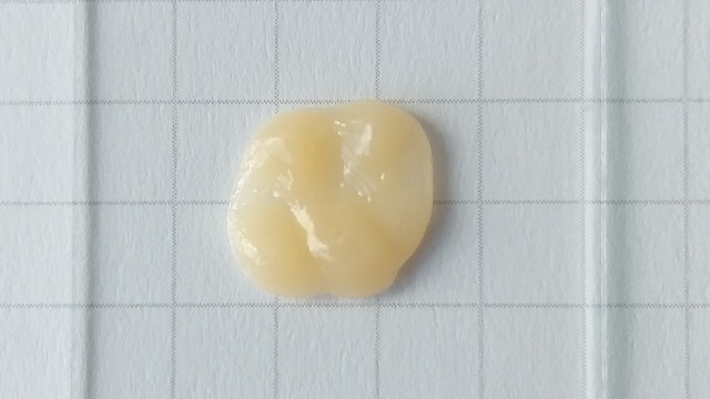The occlusal veneer was printed within 20 minutes with remarkable dimensional accuracy.