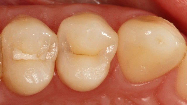 Hidden interproximal caries in the distal surface of a 1st upper left premolar.