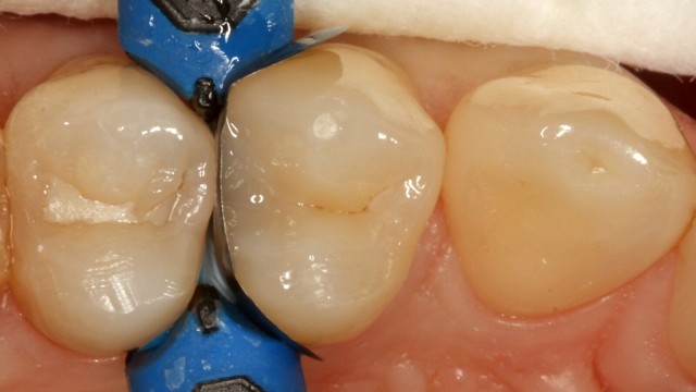 Restoring a tooth with Venus Bulk Flow ONE