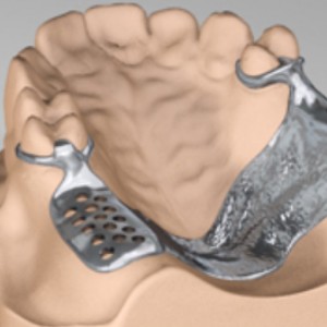 Cast Partial Denture System