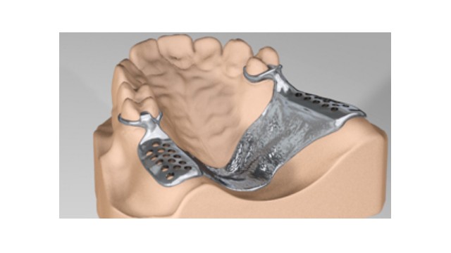 Cast Partial Denture System