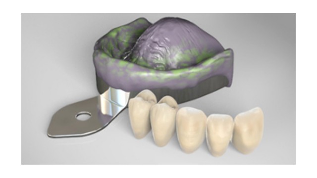 Prosthetic Materials