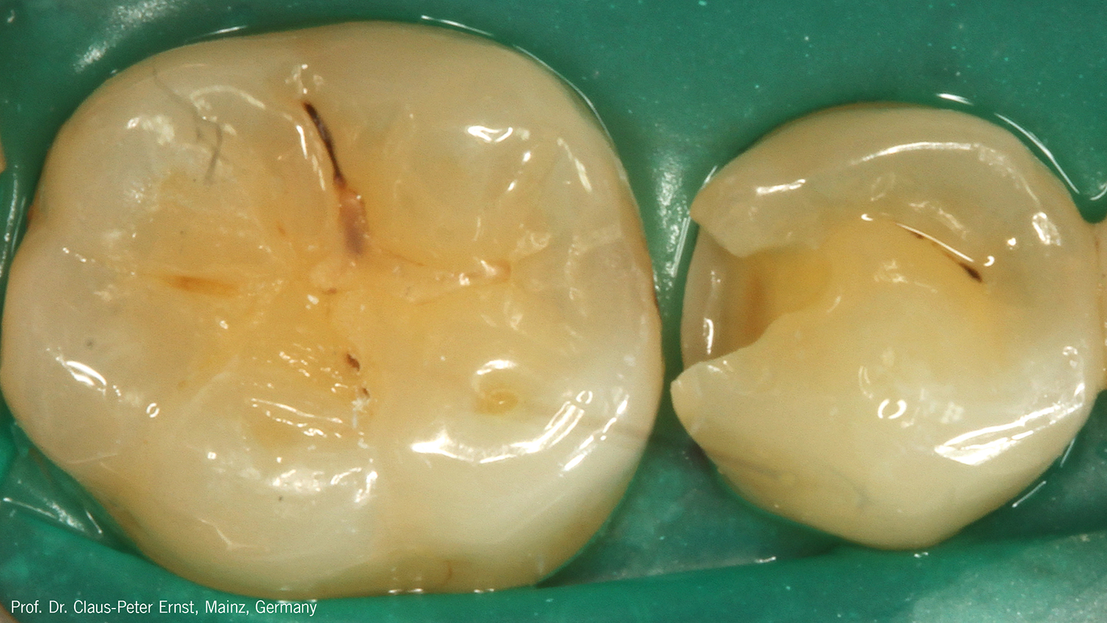 Excavated and preparated cavity under rubberdam-isolation.