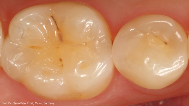 Clinical follow-up after 4 weeks.