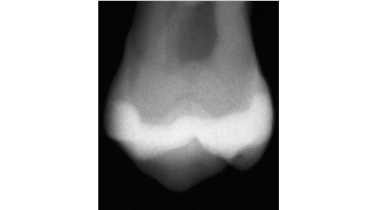 Charisma Classic x-ray restauration left with Charisma F E