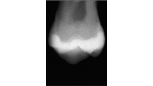 Charisma Classic x-ray restauration left with Charisma F E