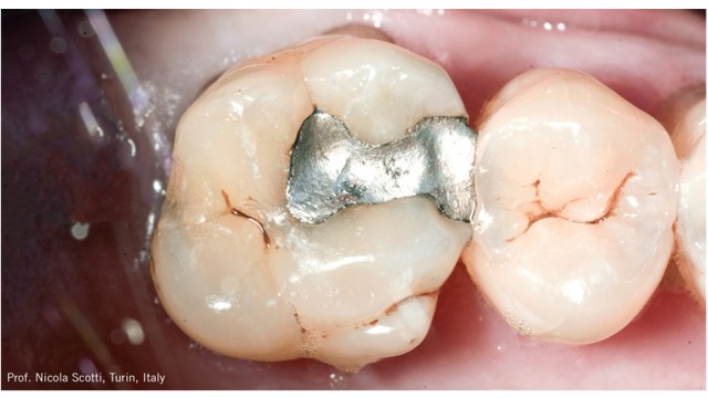 Secondary caries on the amalgam restoration of tooth 26​