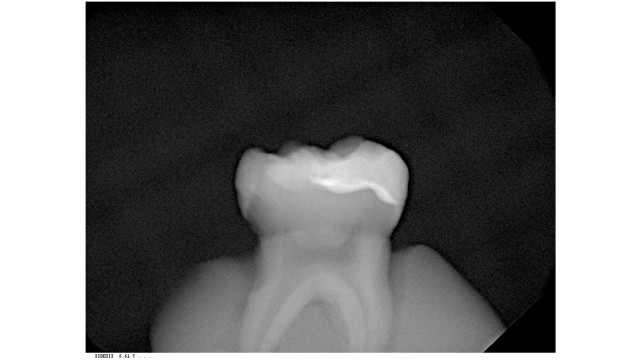 Charisma Opal Flow x-ray NEFL baseliner