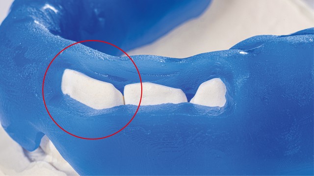 Well fitting of 3D-printed Mouth Guards 