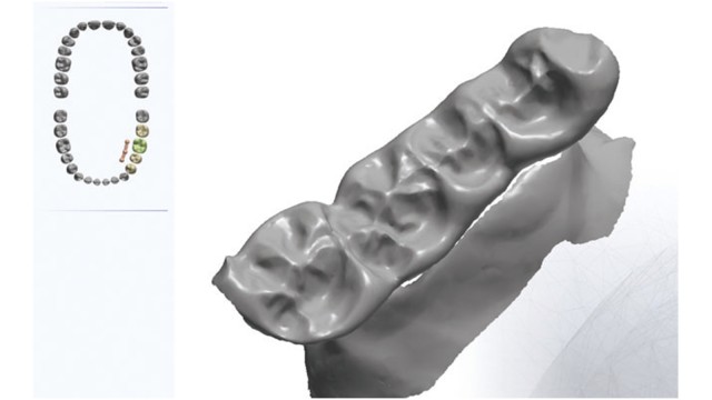 Powder-free optical 3D data recording of antagonists for CAD/CAM technology