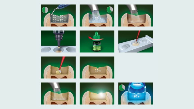 Step-by-step application GLUMA Bond5