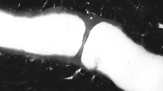 Gluma-induced septum in dentinal tube