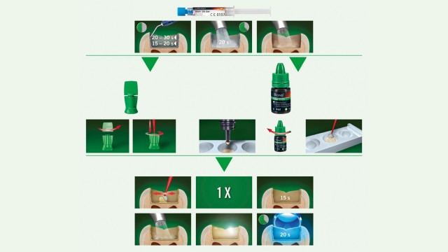 iBOND Total Etch – Step-by-step application