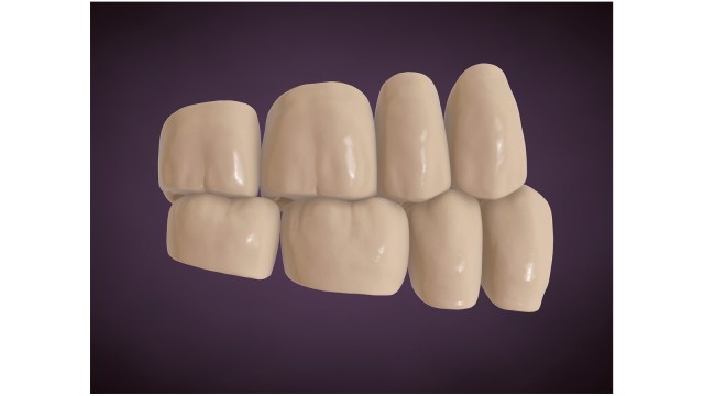 Tooth-to-two-teeth occlusion