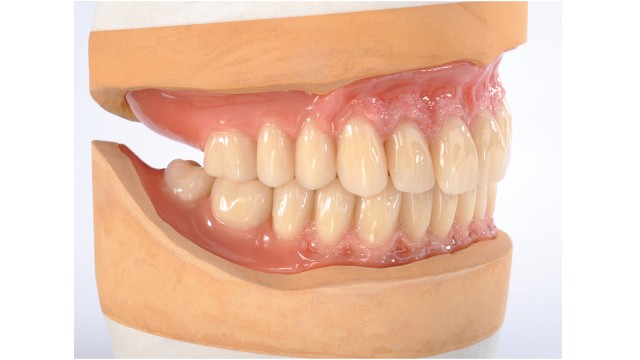 Pala Idealis denture modell