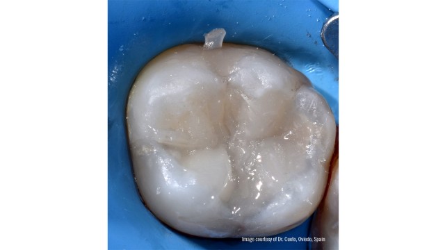  rebuilding the palatal triangular ridges