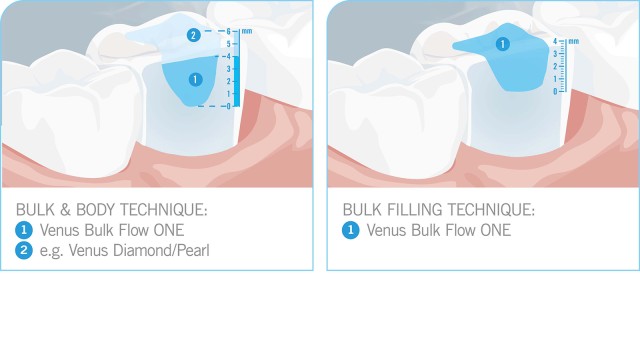 Venus® Bulk Flow ONE