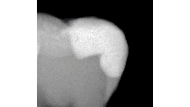 On X-ray: Reliable differentiation between composite filling and residual tooth structure.
