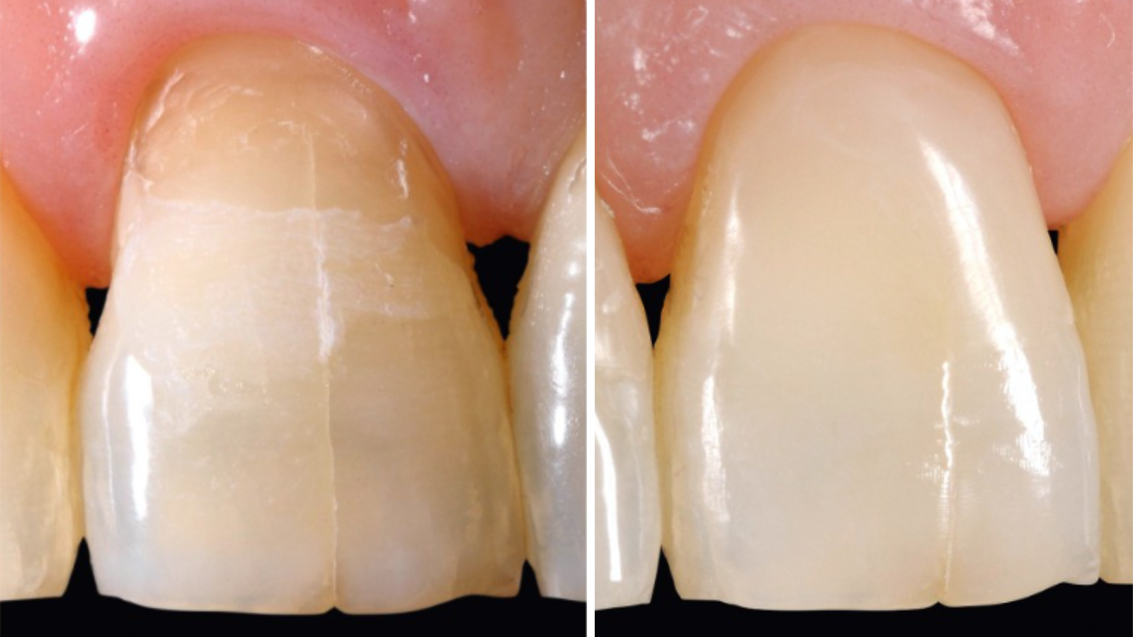 Class V restoration with Venus Diamond Flow Art Shades. Case by Ulf Krueger-Janson, Germany.