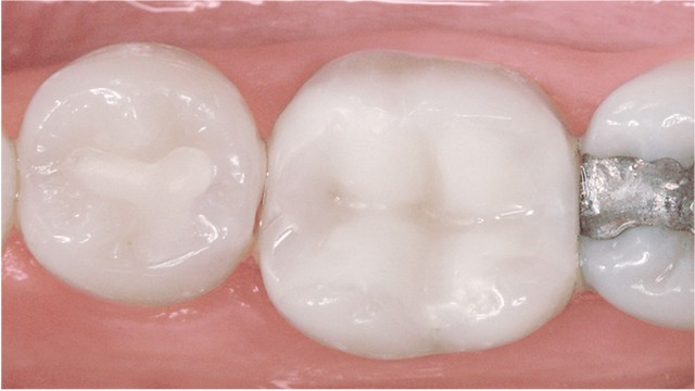 Venus Flow case, 4 years after application, Picture 4