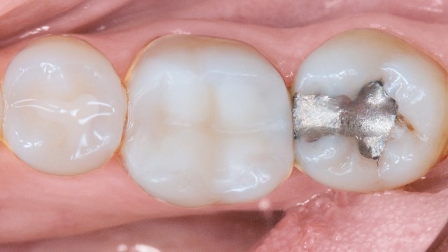 Venus Flow case, After application, Picture 3