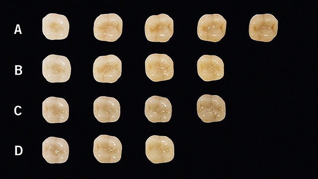 Teeth filled with Venus Pearl ONE Shade.