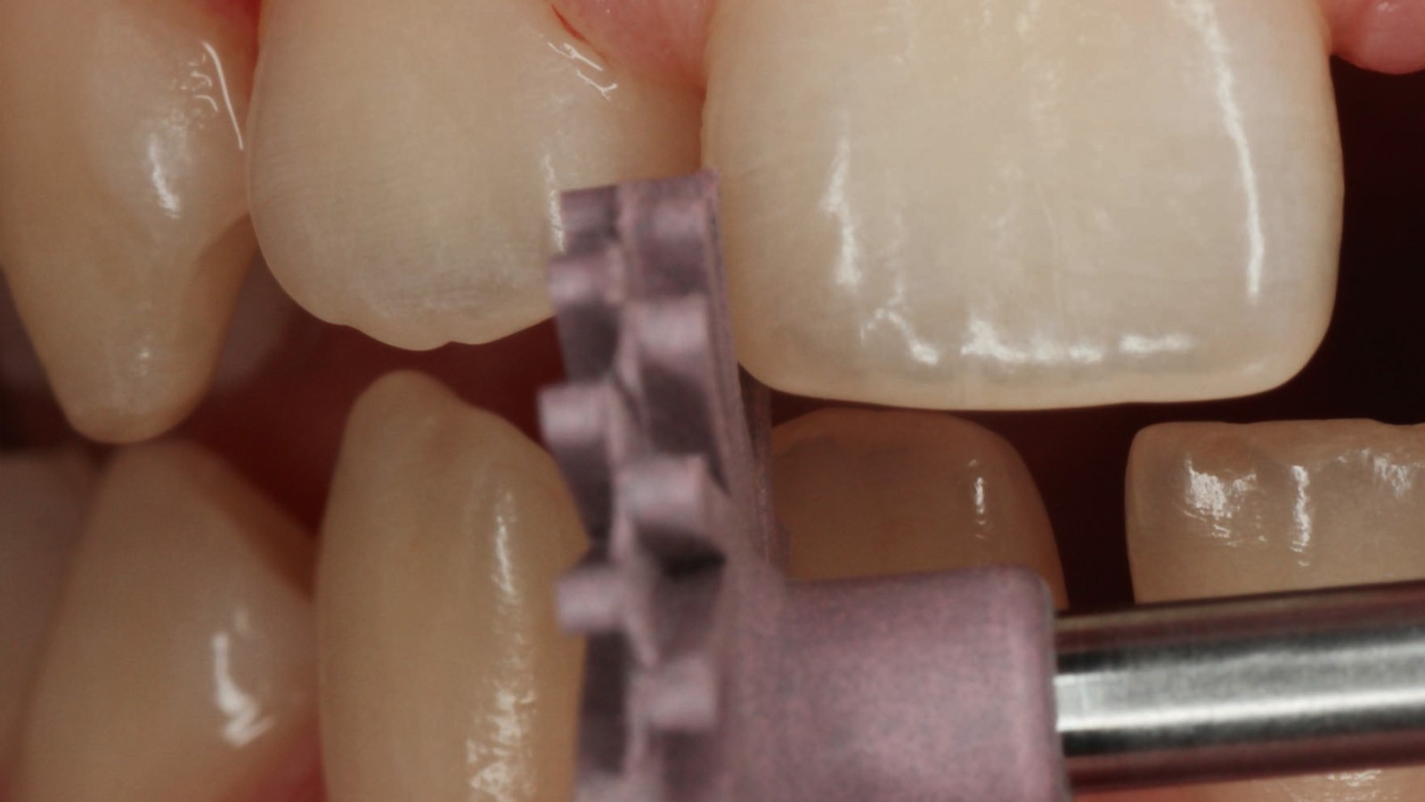 Interdental