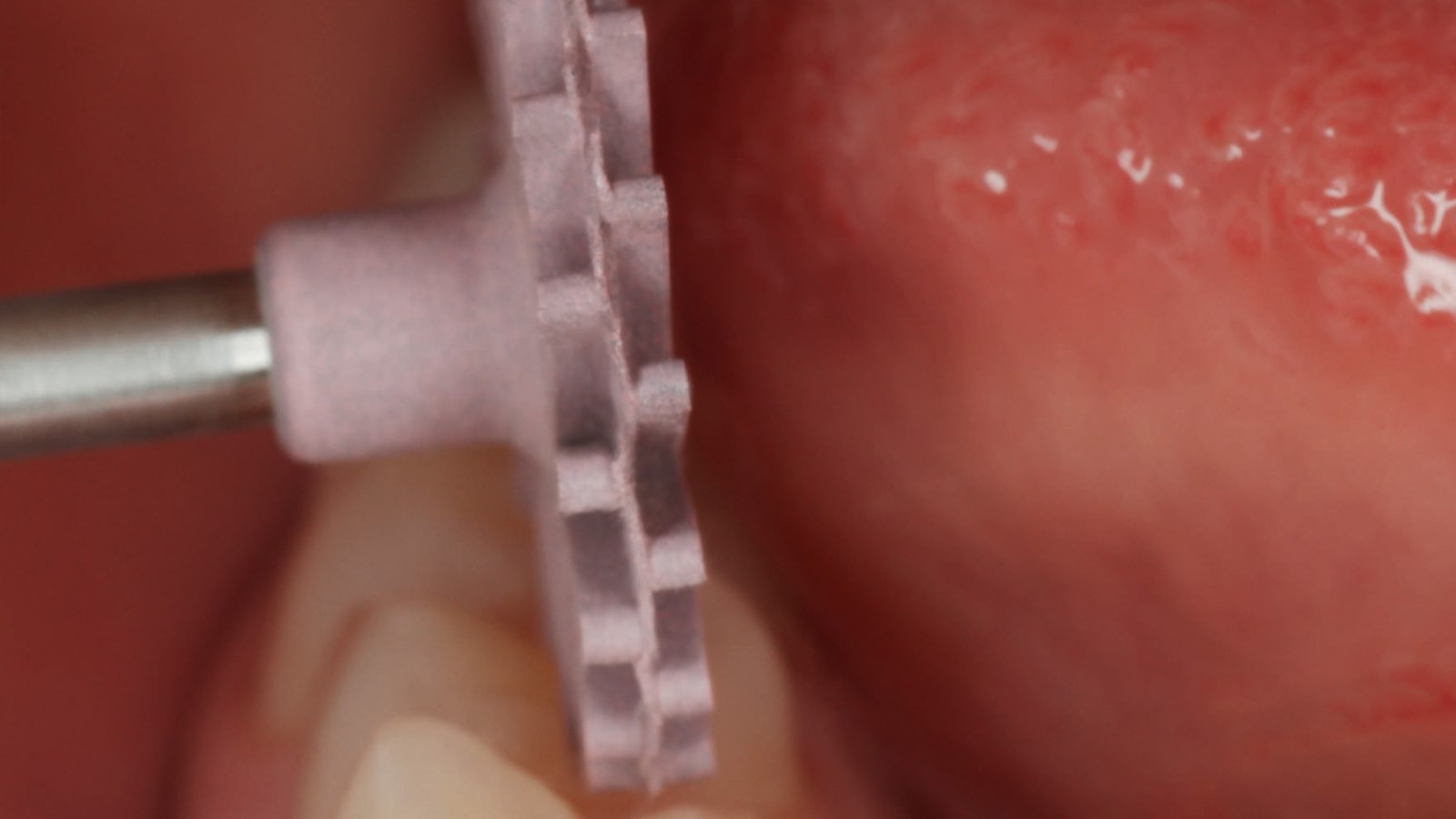 Occlusal