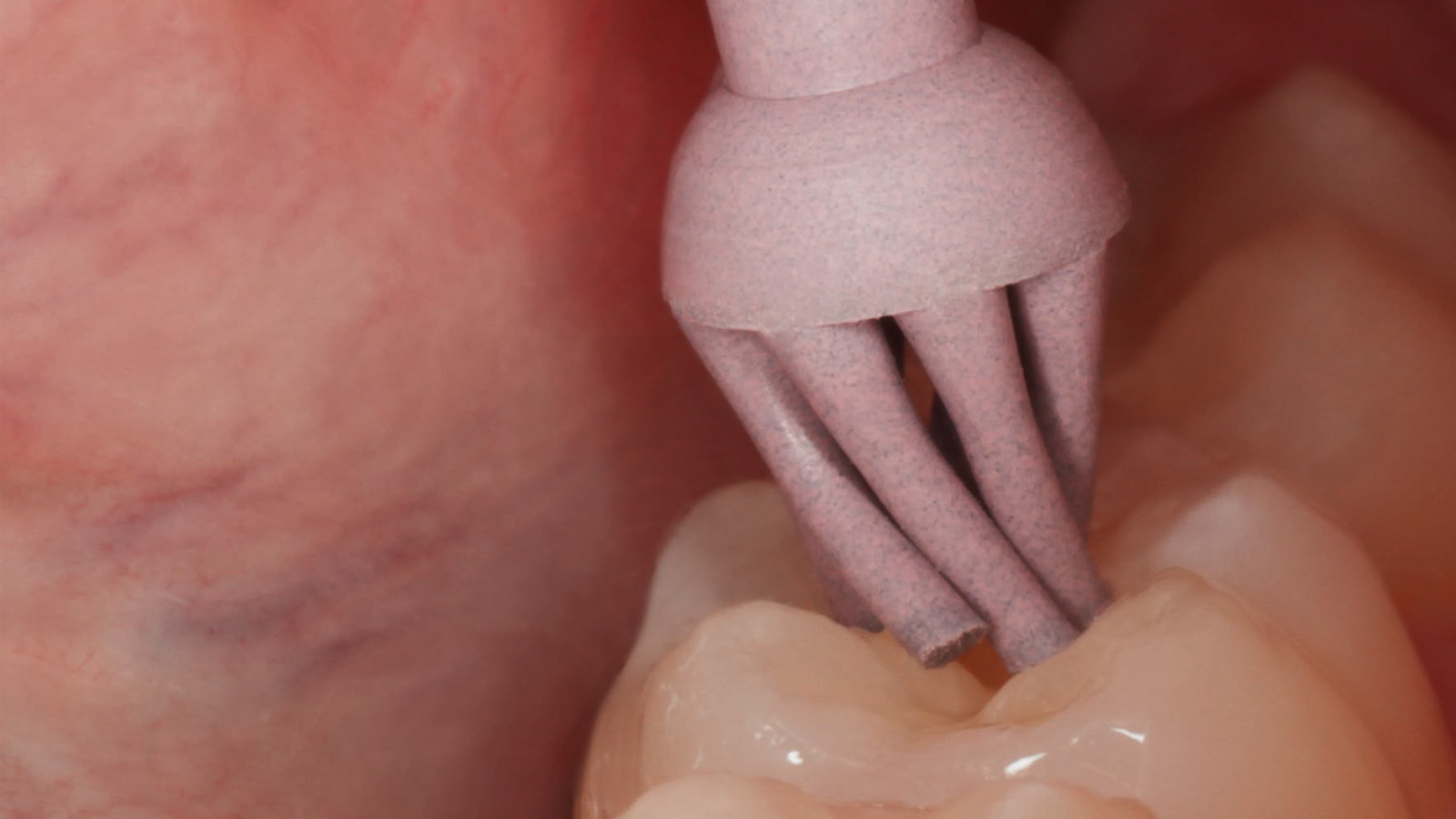 Ideal results on fissures: Twist Brush