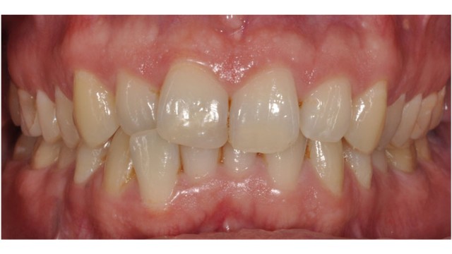 Malocclusion of the right lower lateral incisal