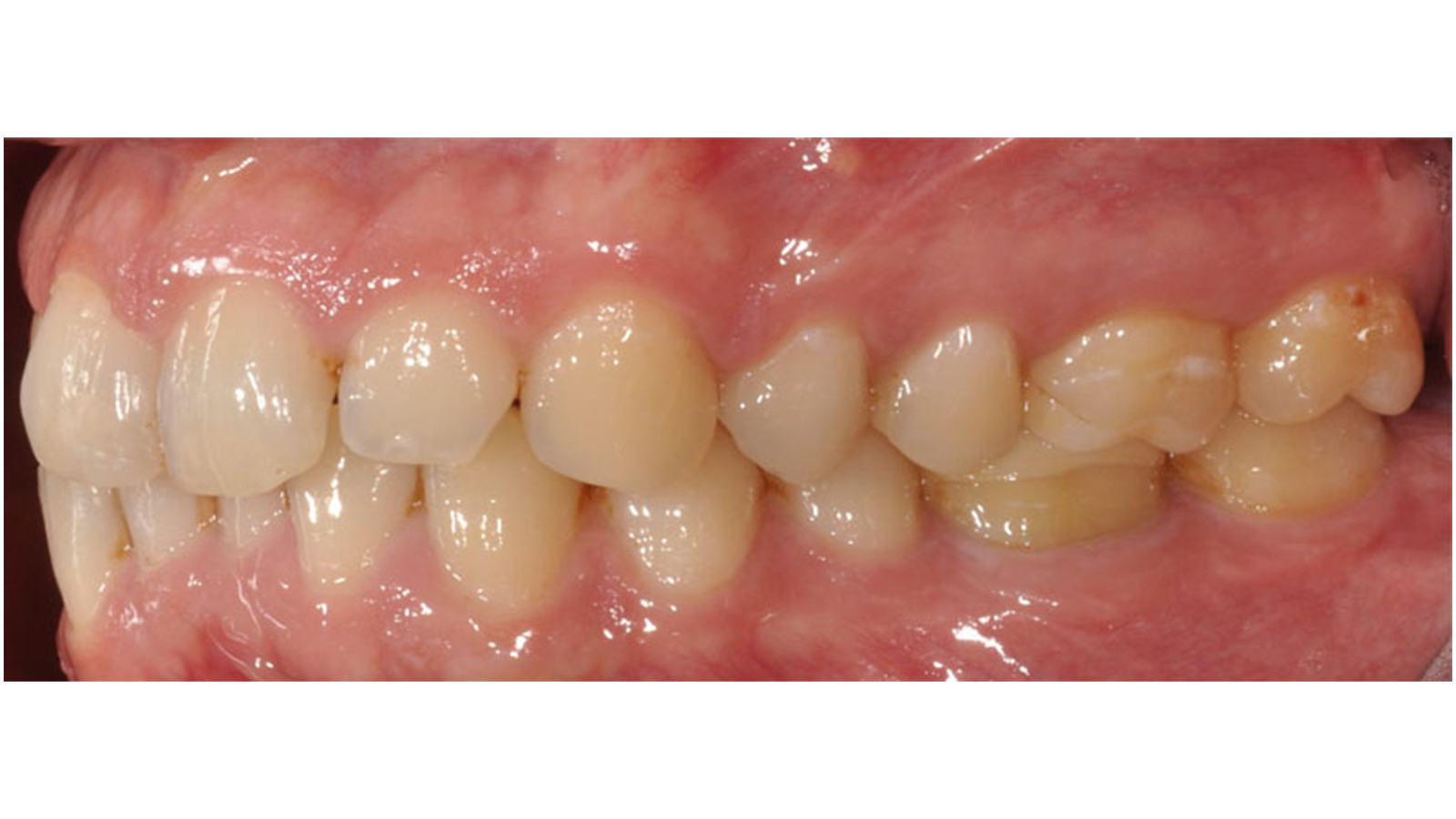 Left lateral view on occlusion