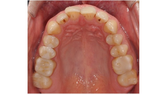 Maxillary dental arch