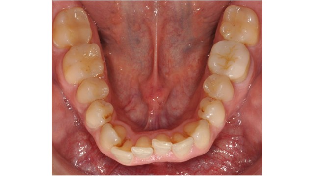 Mandibular dental arch