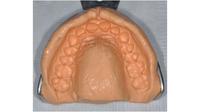 Homogenous xantasil impression of maxilla