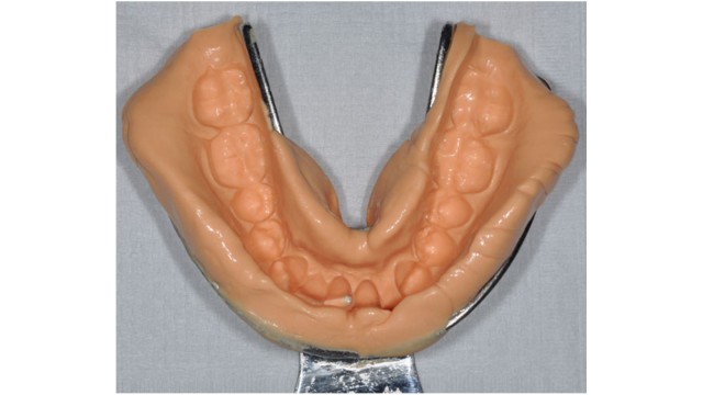 Perfect result of mandibular impression