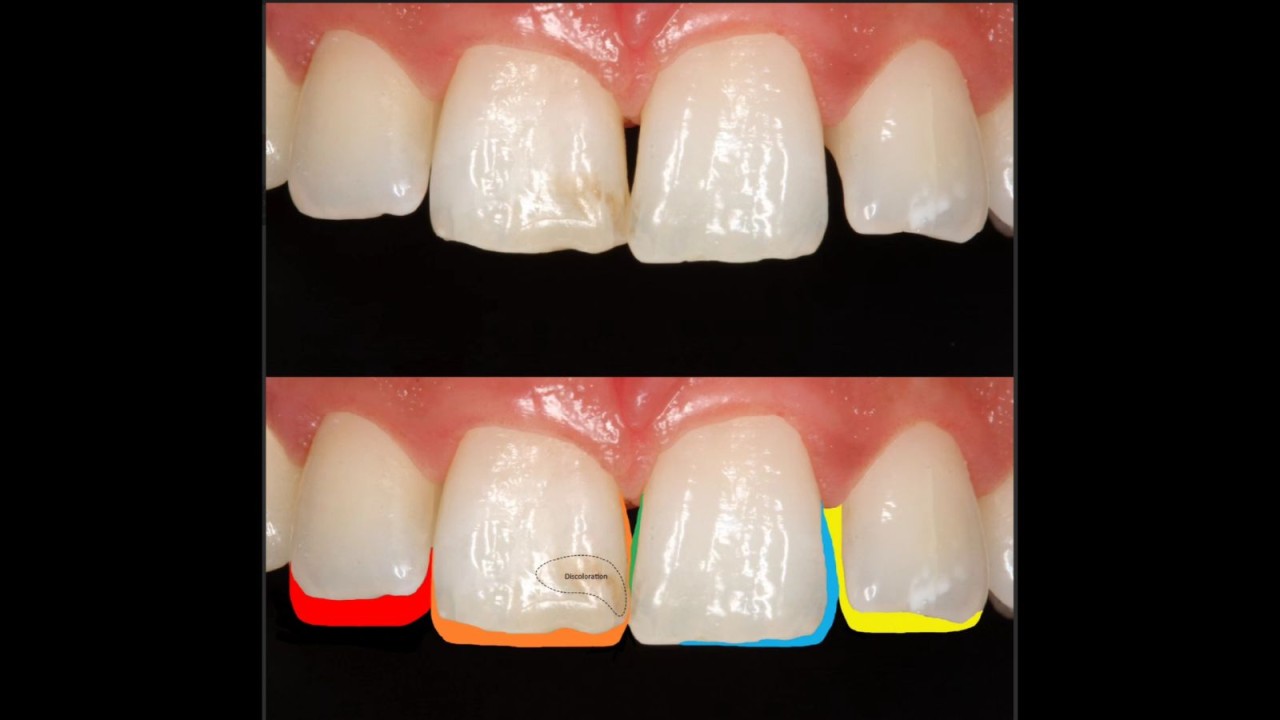 Mapping for the areas which need composite reconstruction