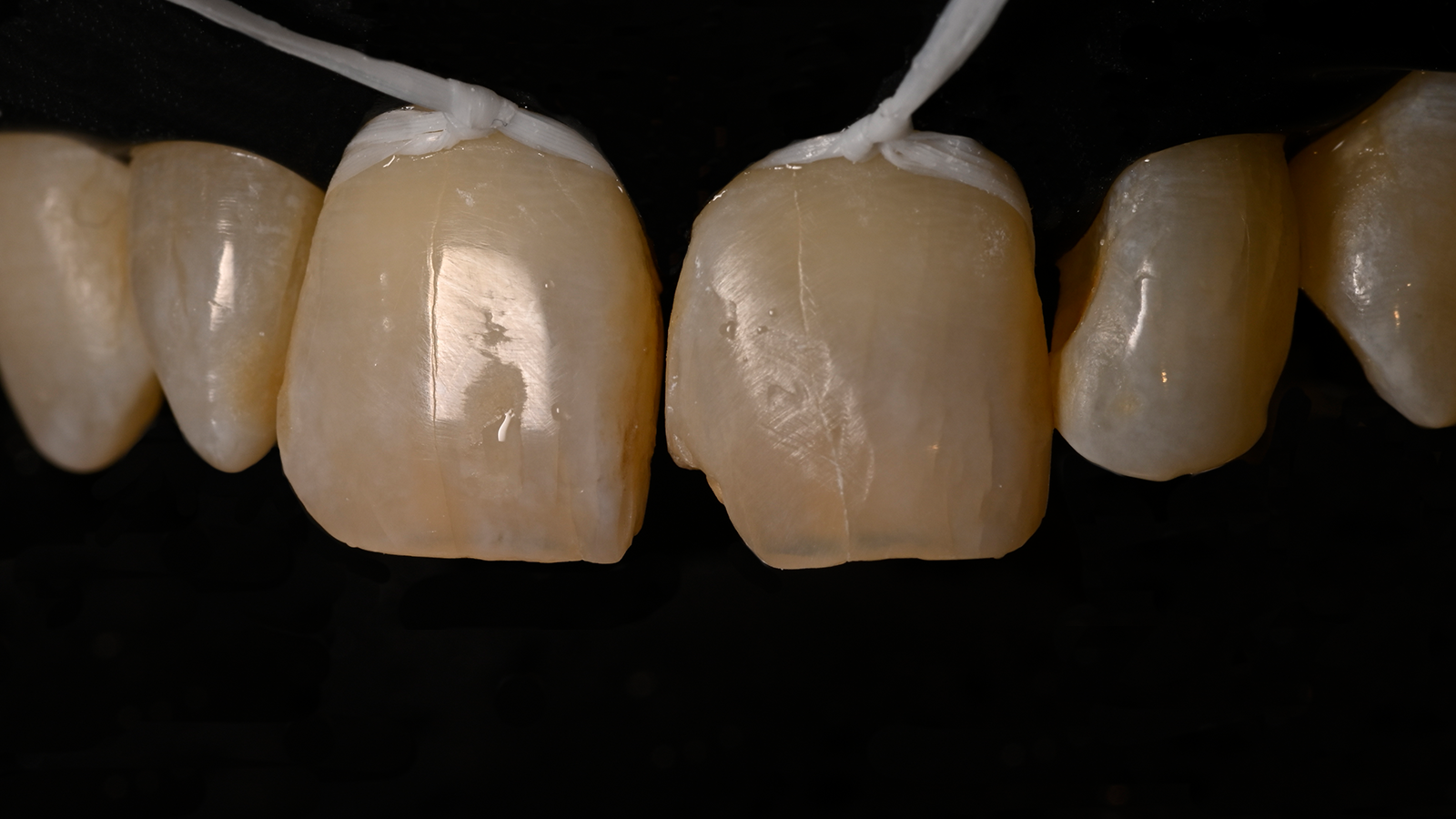 Prepared class IV cavity
