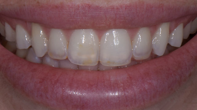 Before