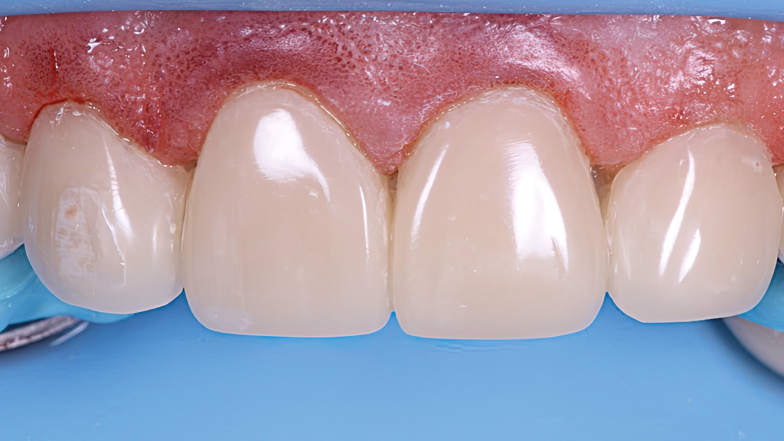 thumbnail image 2 of Kulzer Venus Pearl Universal Nanohybrid Composite PLT 10-Pack - Bleach Light Shade 2 of 6