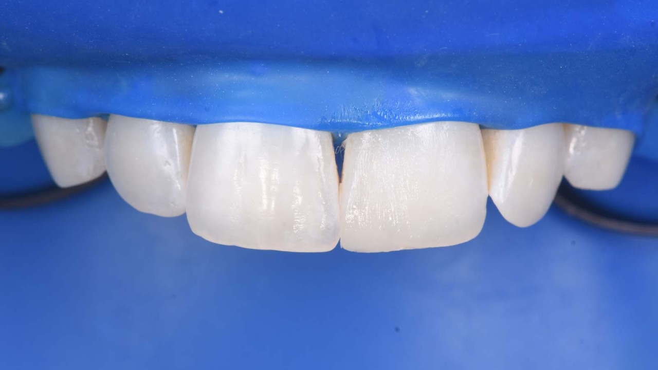 The composite build-up is completed. 