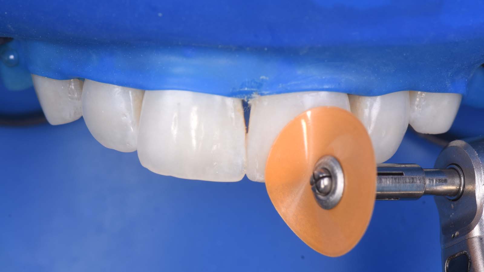 These discs are used on the incisal edge and buccal area of the tooth.