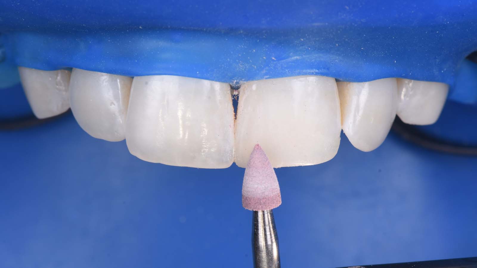 Polishing the composite with the Venus Supra polishing kit.