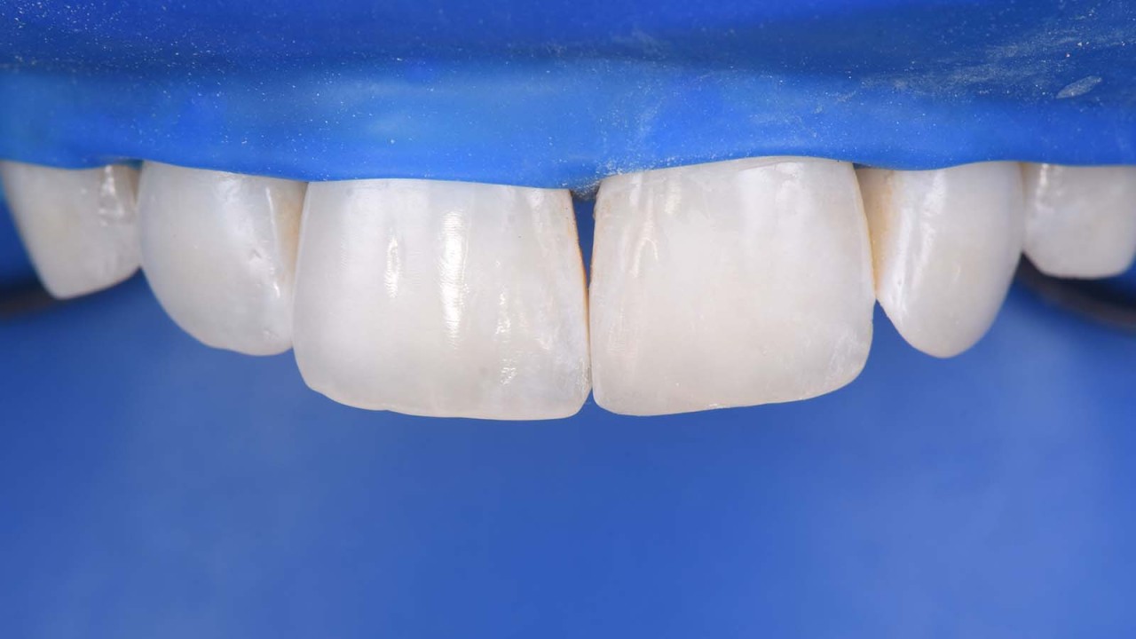 End of polishing before removing the operative field.